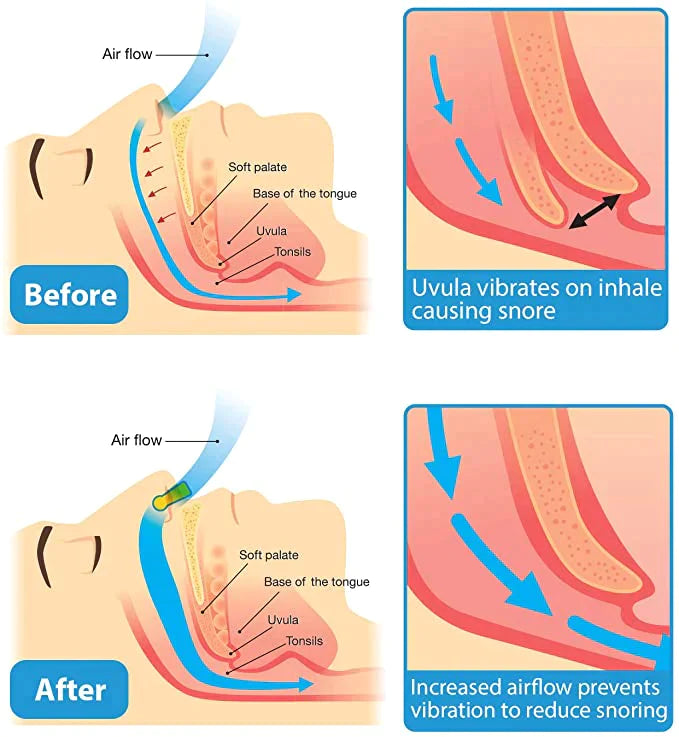 ¡AMPLÍA TU PEDIDO! CLIP MAGNETICO ANTIRONQUIDOS SLEEPYPAL