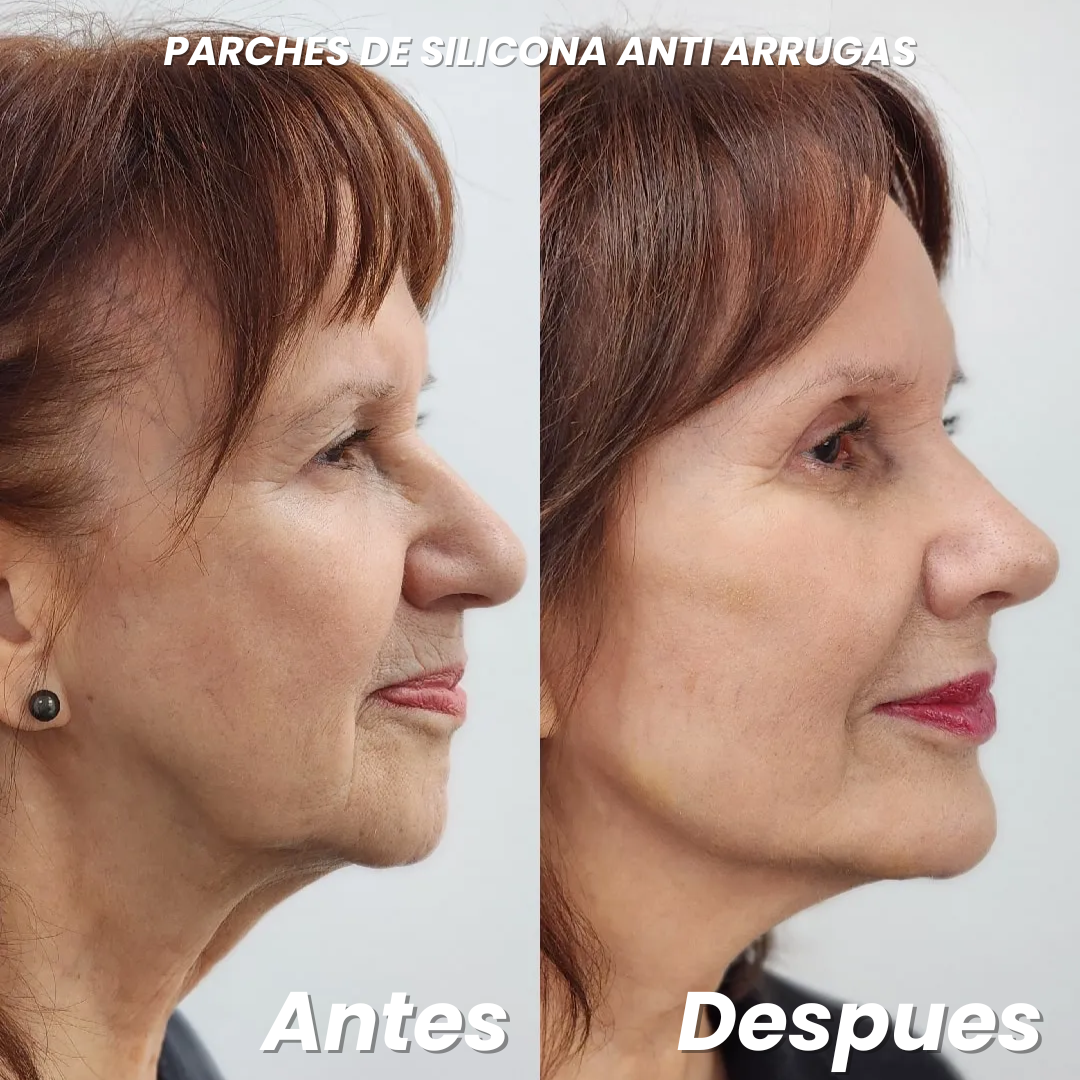 ¡EXCLUSIVO!  BELLA TAPE ® | PARCHES  DE  SILICONA ANTI ARRUGAS
