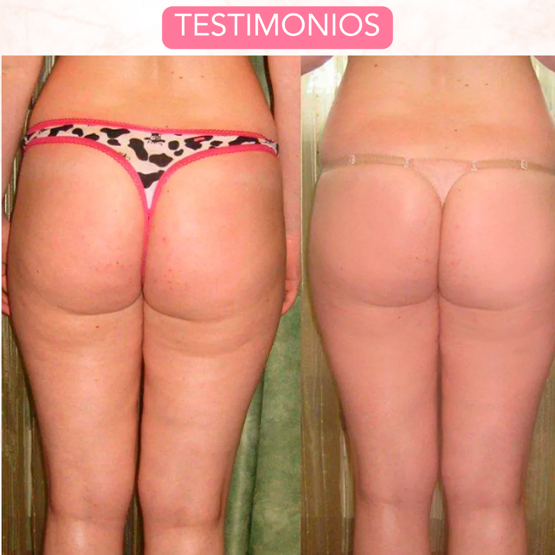 ¡ULTIMAS UNIDADES! DERMAPULSE MASAJEADOR CON VENTOSAS ANTICELULITICAS