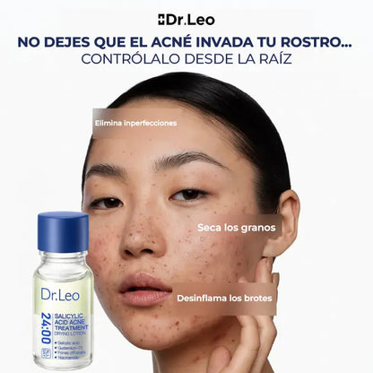 ¡PRODUCTO IMPORTADO 🇺🇲! 🇺🇸 | Destructor de Acné Dr.Leo + hisopo de aplicación✨