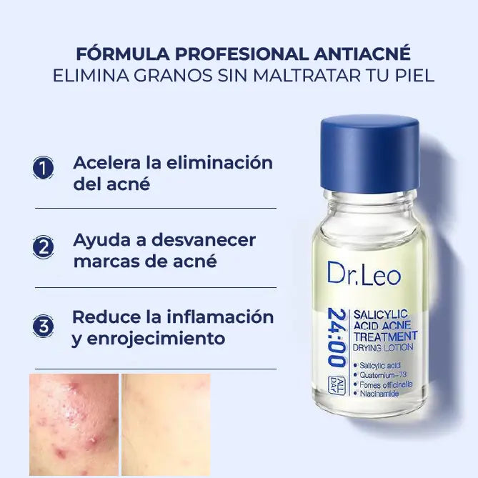 ¡PRODUCTO IMPORTADO 🇺🇲! 🇺🇸 | Destructor de Acné Dr.Leo + hisopo de aplicación✨