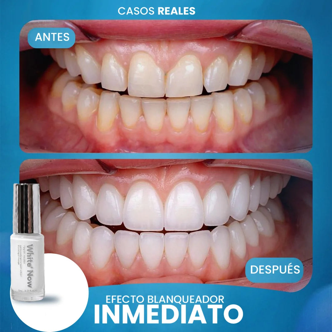 WhiteNow™ BLANQUEADOR DENTAL SET X2 | SONRISA BLANCA